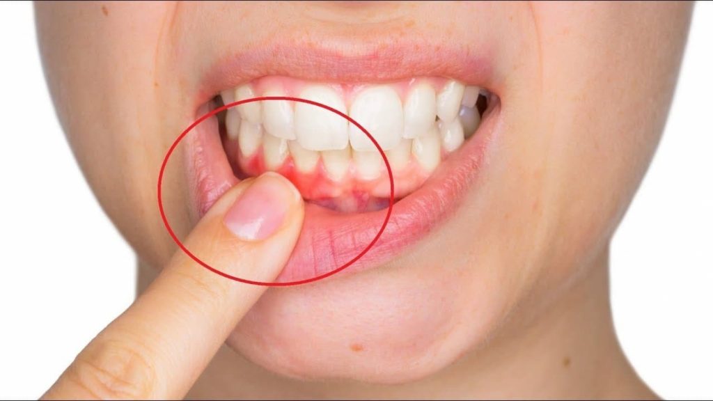 Коронавирус лишает человека зубов и провоцирует воспаление десен