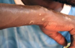 В Сенегале более ста человек заболели неизвестной болезнью