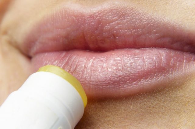 Эксперты рассказали, как вылечить простуду на губах