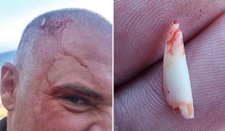 Акула сломала зуб об голову мужчины