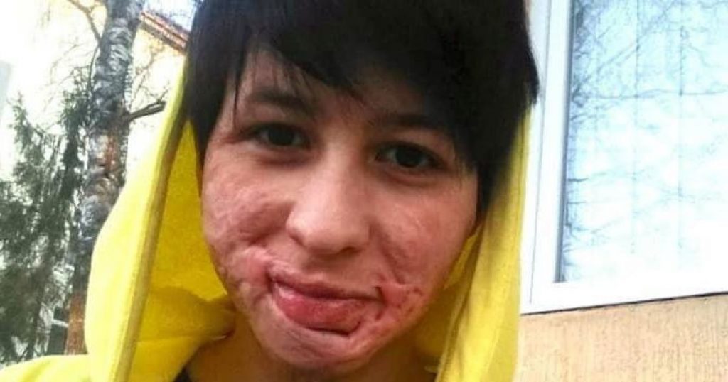 Девушке из Черновцов, которую поджег отец, сделали пластическую операцию