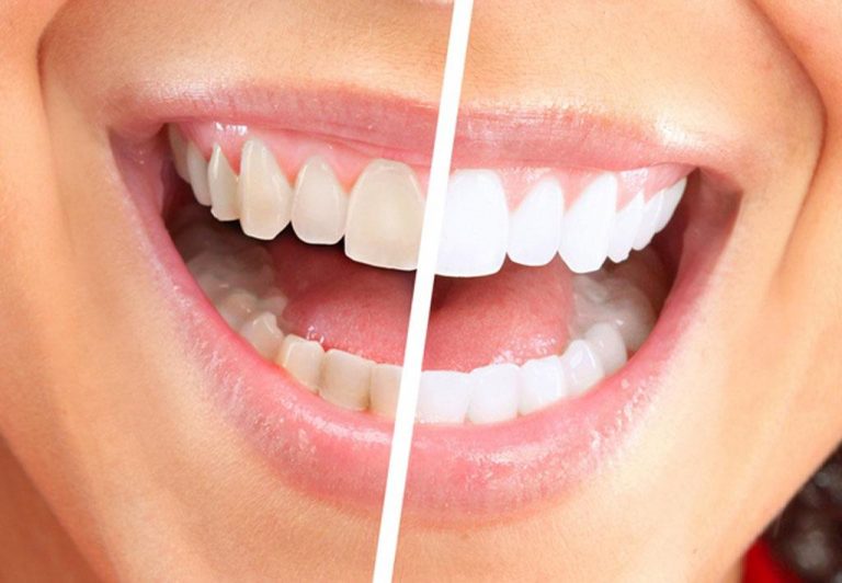 Стоматологи назвали причину желтизны зубов