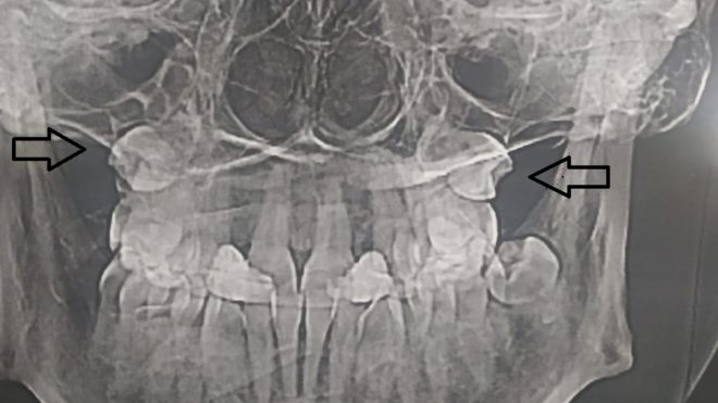 Хирурги удалили женщине зубы из неожиданного места