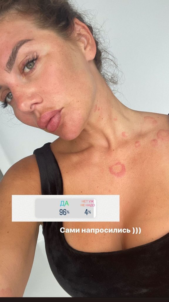 Анна Седокова показала последствия тяжелой аллергической реакции (ФОТО)
