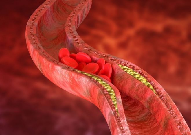 Почему бляшки в артериях опасны: ответ врача