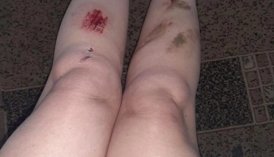 В Запорожье девушка упала в открытый люк и получила травмы (ФОТО)