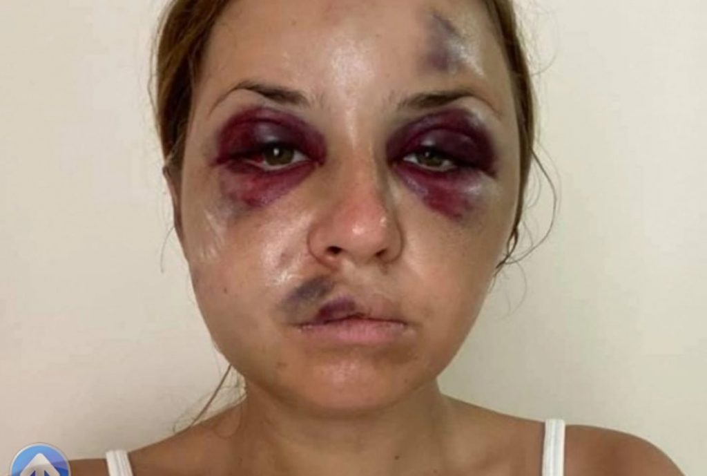 «Укрзализныця» выплатила компенсацию избитой в поезде журналистке (ФОТО)