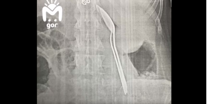 В России 28-летняя женщина проглотила три столовых ложки (ФОТО)