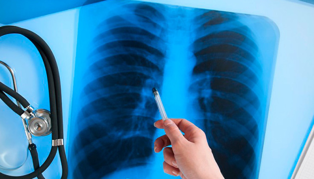 Люди умирают от туберкулеза, но выявляют его только при вскрытии &#8211; эксперт