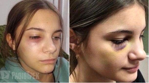 Семиклассник в Ровно избил школьницу: сотрясение мозга (ФОТО)