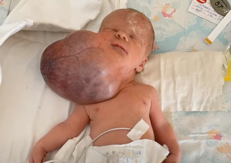 «Вдвое больше головы»: врачи удалили у младенца гигантскую опухоль (ФОТО, ВИДЕО)