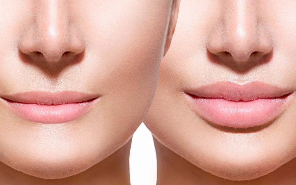Косметолог рассказал, почему увеличение губ косметологическим способом таит опасность