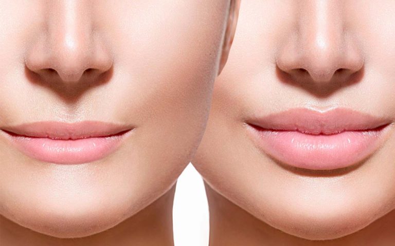 Косметолог рассказал, почему увеличение губ косметологическим способом таит опасность