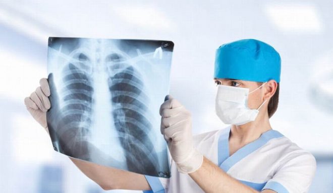 В Киевской области увеличилось число заболевших туберкулезом