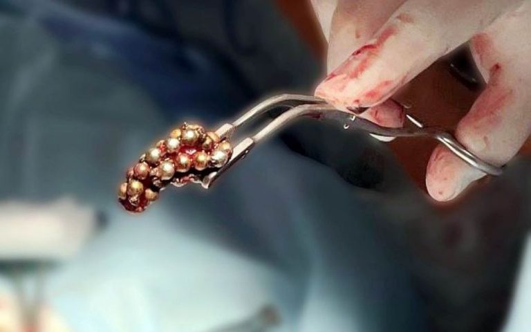 На Волыни госпитализировали подростков с магнитными шариками в мочевом пузыре (ФОТО, ВИДЕО)