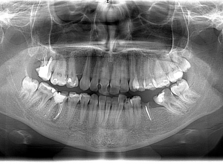 Рентген зубов может привести к раку мозга &#8212; исследование