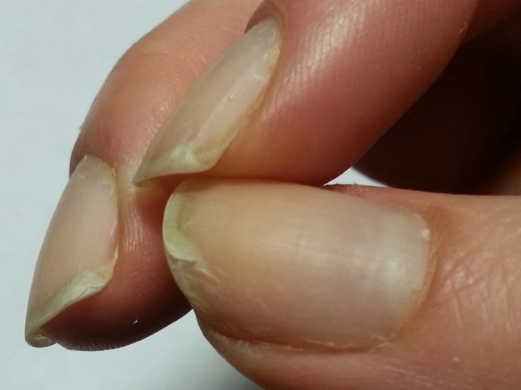 Attēlu rezultāti vaicājumam “Признаки рака: почему важно следить за своими ногтями”