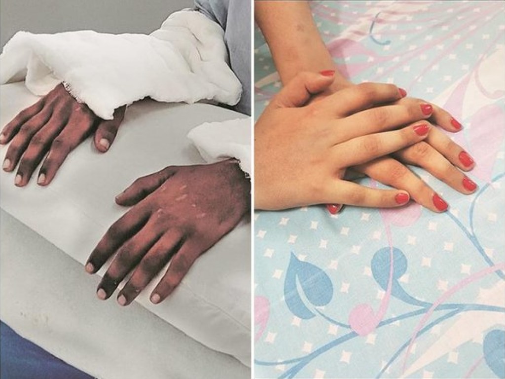 В Индии пересаженные девушке руки донора-мужчины сменили цвет и форму (ФОТО, ВИДЕО)
