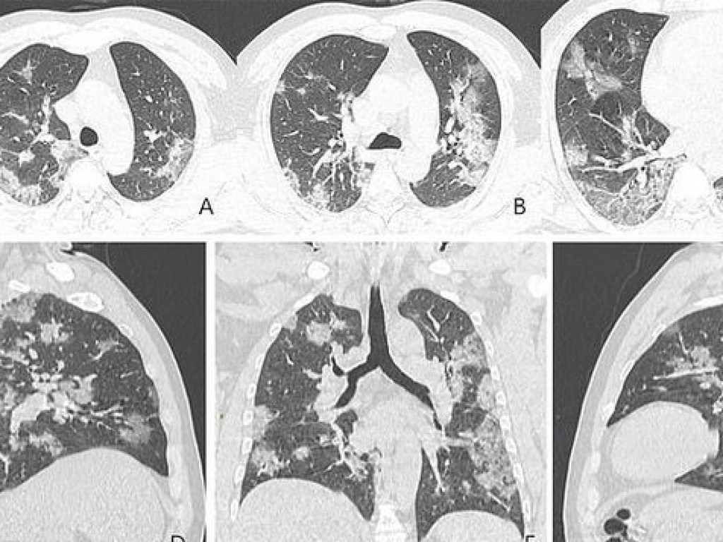 Рентгеновские снимки легких умершего от коронавируса мужчины попали в интернет (ФОТО)