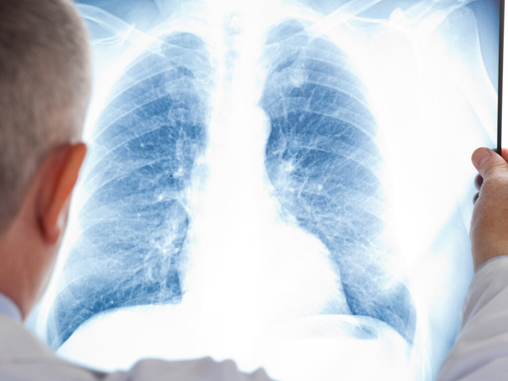 Как выявить пневмонию до похода к врачу: медики дали совет